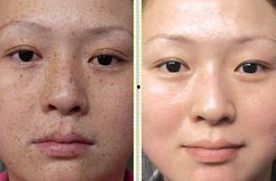 徒手祛斑爆料视频教程图片